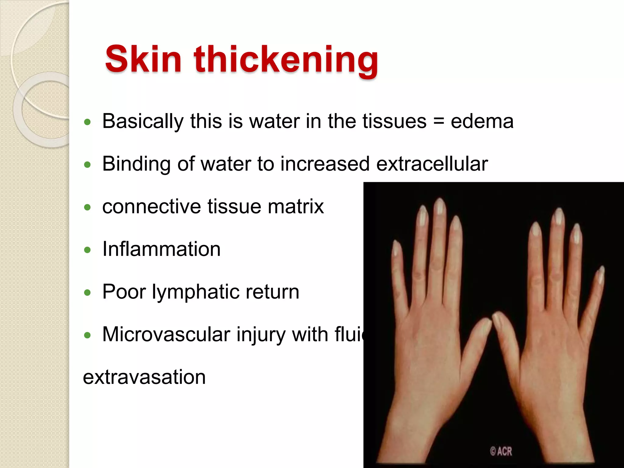 Skin thickening
 Basically this is water in the tissues = edema
 Binding of water to increased extracellular
 connective tissue matrix
 Inflammation
 Poor lymphatic return
 Microvascular injury with fluid
extravasation
 