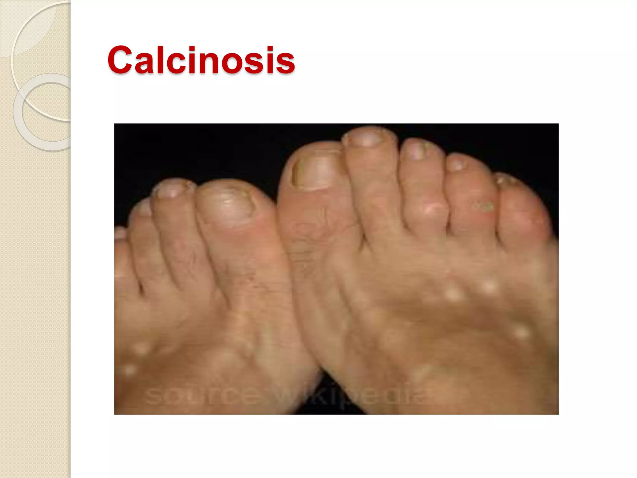 Calcinosis
 