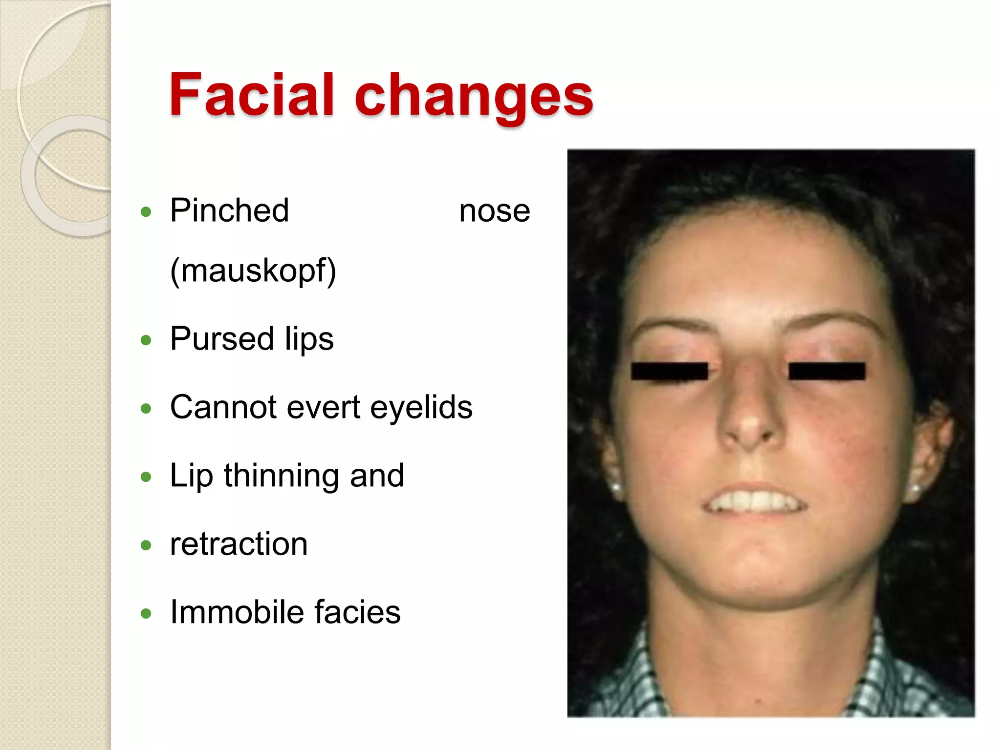 Facial changes
 Pinched nose
(mauskopf)
 Pursed lips
 Cannot evert eyelids
 Lip thinning and
 retraction
 Immobile facies
 