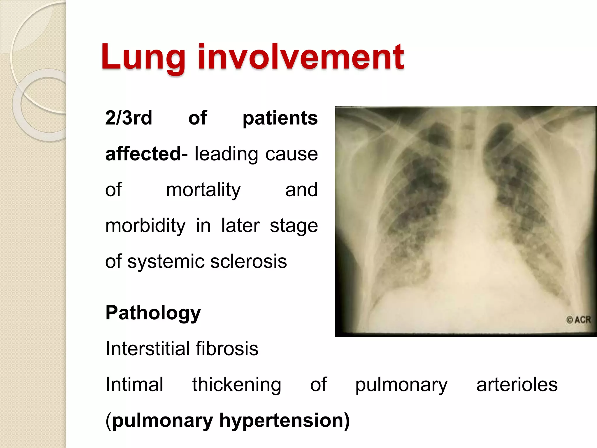 Lung involvement
2/3rd of patients
affected- leading cause
of mortality and
morbidity in later stage
of systemic sclerosis
Pathology
Interstitial fibrosis
Intimal thickening of pulmonary arterioles
(pulmonary hypertension)
 
