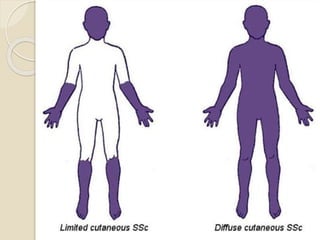 Scleroderma | PPTX