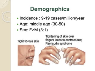 Scleroderma | PPTX