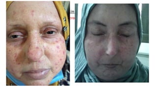 II- Skin changes:
Initially swollen, puffy (pre-scleroderma) later become tight.
 