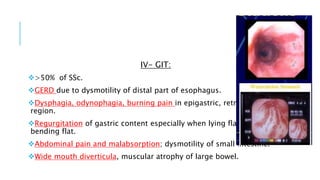 IV- GIT:
>50% of SSc.
GERD due to dysmotility of distal part of esophagus.
Dysphagia, odynophagia, burning pain in epigastric, retrosternal
region.
Regurgitation of gastric content especially when lying flat or
bending flat.
Abdominal pain and malabsorption; dysmotility of small intestine.
Wide mouth diverticula, muscular atrophy of large bowel.
 