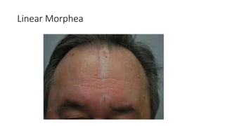scleroderma.pptx