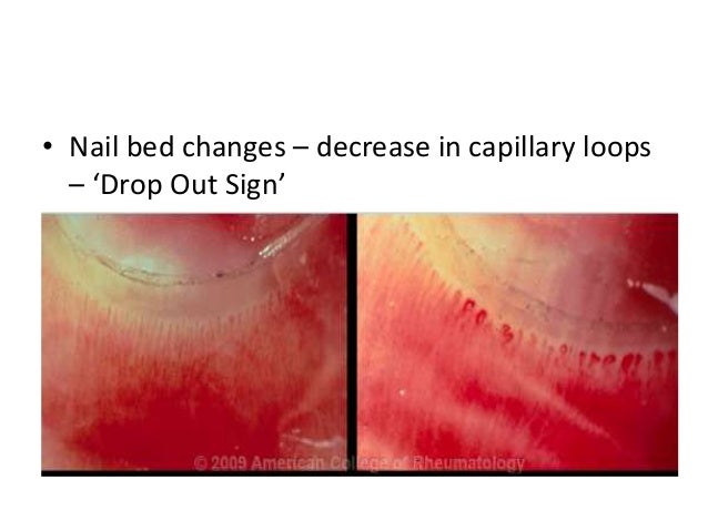 Scleroderma by aseem