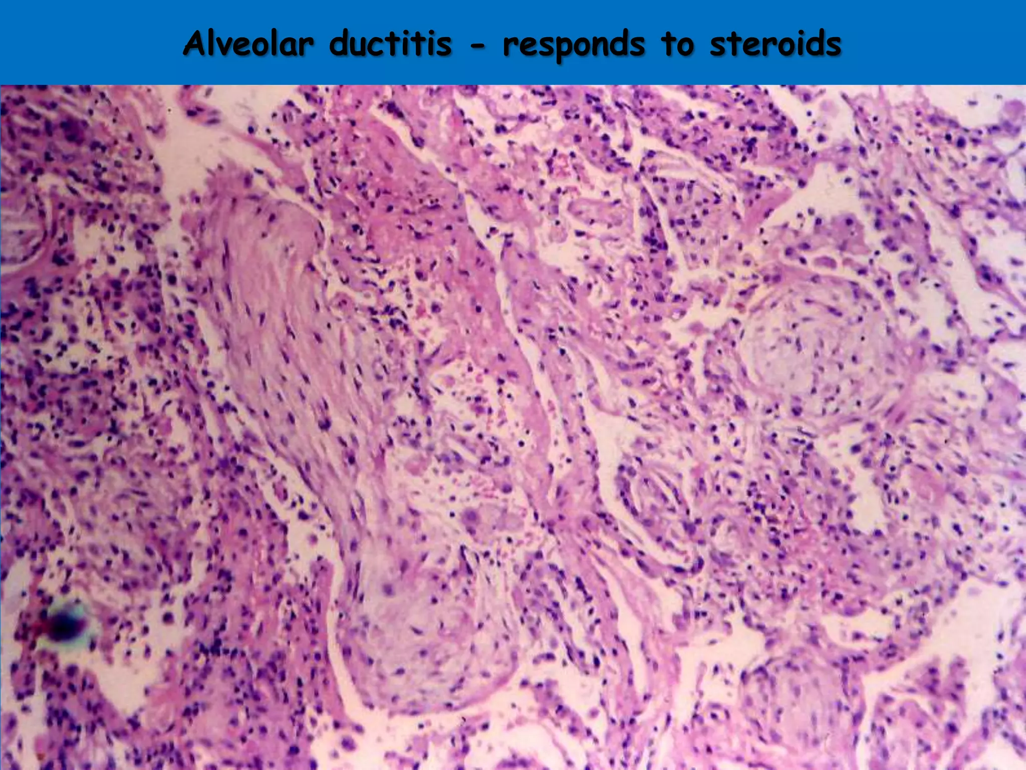 Alveolar ductitis - responds to steroids
 
