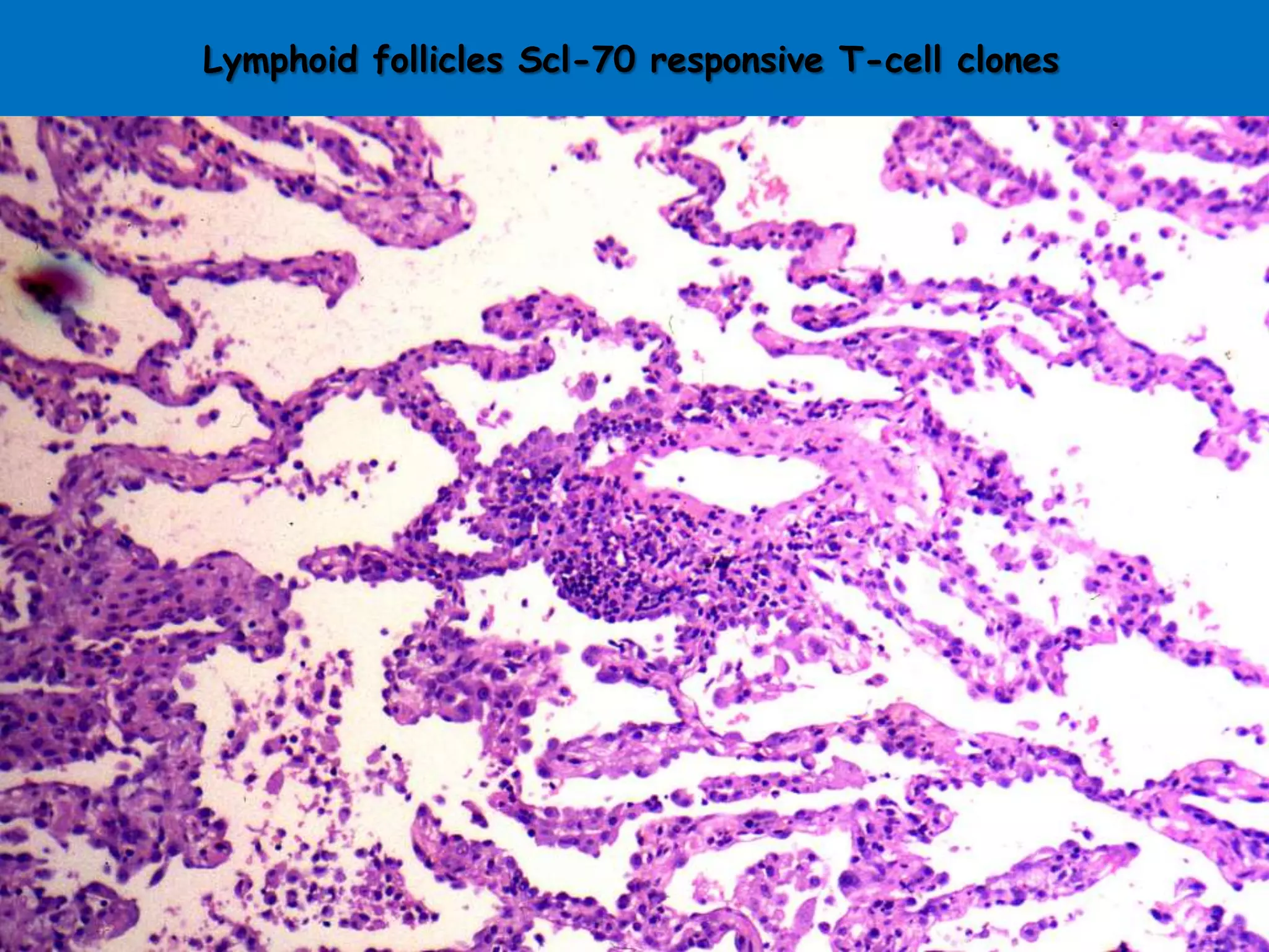 Lymphoid follicles Scl-70 responsive T-cell clones
 