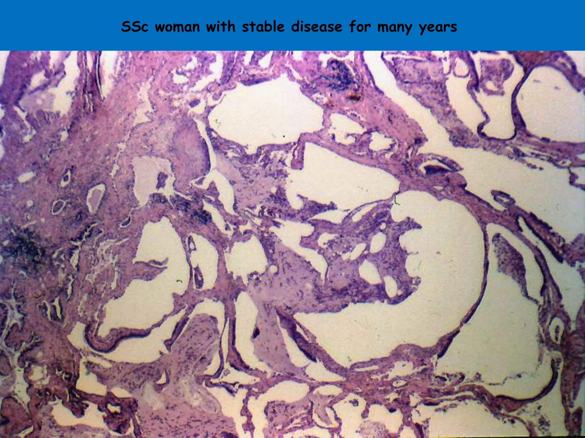 SSc woman with stable disease for many years
 