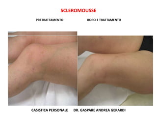 SCLEROMOUSSE
  PRETRATTAMENTO            DOPO 1 TRATTAMENTO




CASISTICA PERSONALE   DR. GASPARE ANDREA GERARDI
 