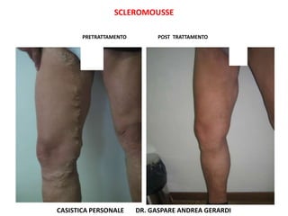 SCLEROMOUSSE

       PRETRATTAMENTO         POST TRATTAMENTO




CASISTICA PERSONALE     DR. GASPARE ANDREA GERARDI
 