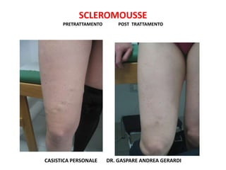 SCLEROMOUSSE
      PRETRATTAMENTO       POST TRATTAMENTO




CASISTICA PERSONALE    DR. GASPARE ANDREA GERARDI
 