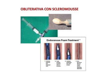 OBLITERATIVA CON SCLEROMOUSSE
 