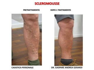 SCLEROMOUSSE
          PRETRATTAMENTO     DOPO 1 TRATTAMENTO




CASISTICA PERSONALE           DR. GASPARE ANDREA GERARDI
 