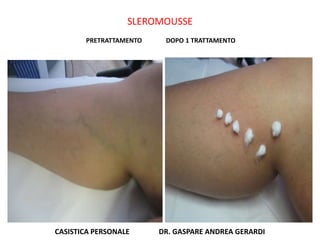 SLEROMOUSSE
       PRETRATTAMENTO    DOPO 1 TRATTAMENTO




CASISTICA PERSONALE     DR. GASPARE ANDREA GERARDI
 