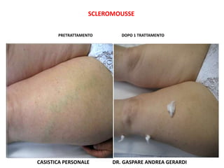 SCLEROMOUSSE


       PRETRATTAMENTO       DOPO 1 TRATTAMENTO




CASISTICA PERSONALE      DR. GASPARE ANDREA GERARDI
 