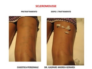SCLEROMOUSSE
   PRETRATTAMENTO          DOPO 1 TRATTAMENTO




CASISTICA PERSONALE   DR. GASPARE ANDREA GERARDI
 