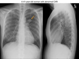 A 41-year-old woman with abnormal CXR 