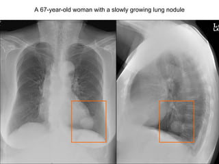 A 67-year-old woman with a slowly growing lung nodule 