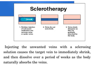 Injecting the unwanted veins with a sclerosing
solution causes the target vein to immediately shrink,
and then dissolve over a period of weeks as the body
naturally absorbs the veins.