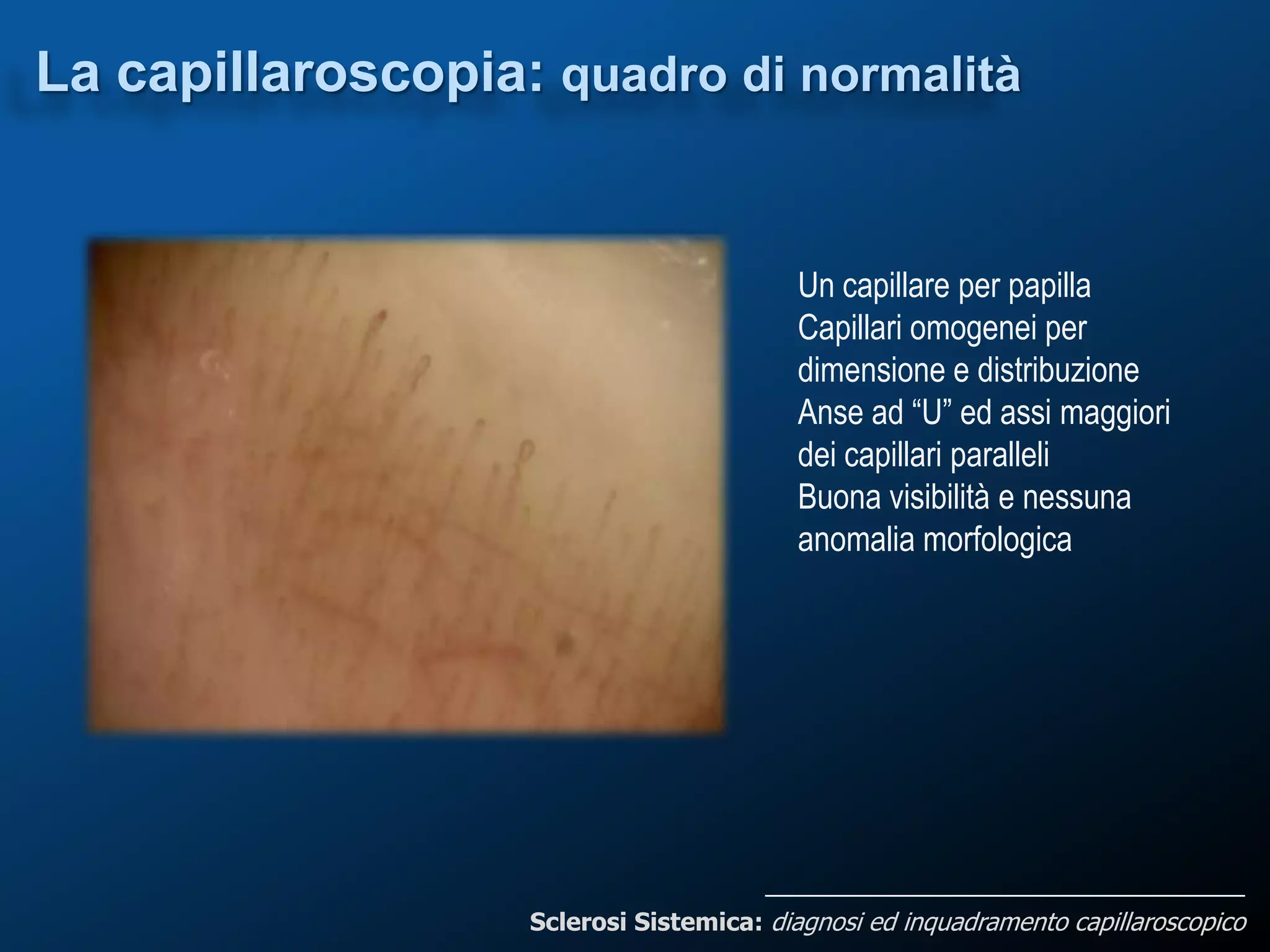 Sclerosi sistemica diagnosi ed inquadramento capillaroscopico | PPTX