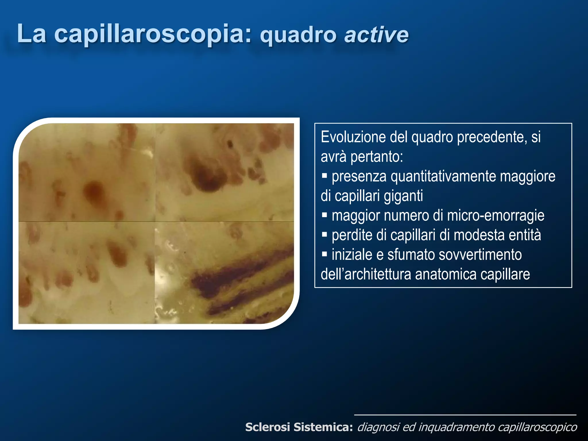 Sclerosi sistemica diagnosi ed inquadramento capillaroscopico | PPTX