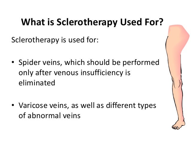 what is sclerotherapy