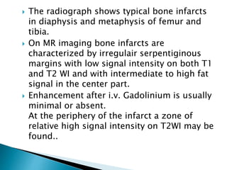  The radiograph shows typical bone infarcts
in diaphysis and metaphysis of femur and
tibia.
 On MR imaging bone infarcts are
characterized by irregulair serpentiginous
margins with low signal intensity on both T1
and T2 WI and with intermediate to high fat
signal in the center part.
 Enhancement after i.v. Gadolinium is usually
minimal or absent.
At the periphery of the infarct a zone of
relative high signal intensity on T2WI may be
found..
 