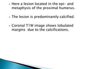 Here a lesion located in the epi- and
metaphysis of the proximal humerus.
 The lesion is predominantly calcified.
 Coronal T1W image shows lobulated
margins due to the calcifications.
 