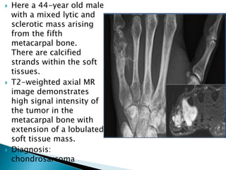  Here a 44-year old male
with a mixed lytic and
sclerotic mass arising
from the fifth
metacarpal bone.
There are calcified
strands within the soft
tissues.
 T2-weighted axial MR
image demonstrates
high signal intensity of
the tumor in the
metacarpal bone with
extension of a lobulated
soft tissue mass.
 Diagnosis:
chondrosarcoma
 