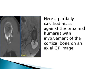 Here a partially
calcified mass
against the proximal
humerus with
involvement of the
cortical bone on an
axial CT image
 