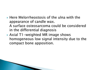  Here Melorrheostosis of the ulna with the
appearance of candle wax.
A surface osteosarcoma could be considered
in the differential diagnosis
 Axial T1-weighted MR image shows
homogeneous low signal intensity due to the
compact bone apposition.
 