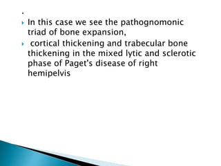 .
 In this case we see the pathognomonic
triad of bone expansion,
 cortical thickening and trabecular bone
thickening in the mixed lytic and sclerotic
phase of Paget's disease of right
hemipelvis
 