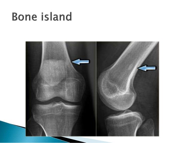 Sclerotic Sclerotic