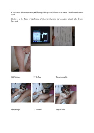 L’opérateur doit trouver une position agréable pour réaliser sont actes en visualisant bien son
écran.

Photos 1 à 9 : Bilan et Technique d’échosclérothérapie par ponction directe (Dr Bruno
burcheri)




1) Clinique                  2) Reflux                     3) cartographie




4) repérage                  5) Mousse                     6) ponction
 