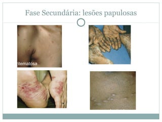 oficina-para-a-preven-o-de-casos-de-s-filis-cong-nita-ppt