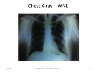 Chest X-ray – WNL
4/2/2017 29DEPARTMENT OF INTERNAL MEDICINE
 