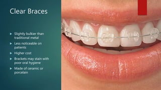 Clear Braces
 Slightly bulkier than
traditional metal
 Less noticeable on
patients
 Higher cost
 Brackets may stain with
poor oral hygiene
 Made of ceramic or
porcelain
 
