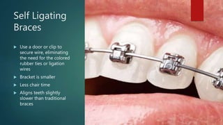 Self Ligating
Braces
 Use a door or clip to
secure wire, eliminating
the need for the colored
rubber ties or ligation
wires
 Bracket is smaller
 Less chair time
 Aligns teeth slightly
slower than traditional
braces
 