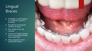 Lingual
Braces
 Available in self-ligating
or traditional type of
brackets
 Bonded to the lingual
surface of tooth
 Not visible from the
outside
 Known to irritate tongue
and surrounding tissues,
may cause lisp
 More expensive than
traditional braces
 