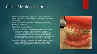 Class II Malocclusion
 Class II malocclusion is where the upper first molar
distal cusp rests in the deepest curvature of the lower
first molar
 Class II malocclusion can be hereditary, commonly
known as “overbite”.
 Class II has two divisions:
 Class II Division I: Where the upper anterior teeth
are protruded and a large overjet is present.
Common characteristics include V shaped arch,
wide in the posterior and narrow in the anterior,
under developed chin and mandible, and failure to
have full lip closure from upper lip shortening
 Class II Division II: Where the upper anterior teeth
are retruded and a deep overbite exists (upper
teeth overlapping lower teeth more than 20%)
 