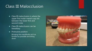 Class III Malocclusion
 Class III malocclusion is where the
upper first molar mesial cusp sits
between the lower first and
second molar
 Class III malocclusion can be
hereditary
 Protrusive position:
Bringing the mandibular arch as
forward as possible and biting
down
 