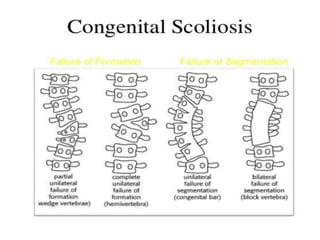 Congenital
scoliosis
 