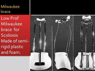 Milwaukee
brace
Low Prof
Milwaukee
brace for
Scoliosis
Made of semi-
rigid plastic
and foam.
 