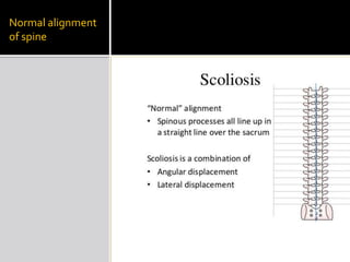 Normal alignment
of spine
 