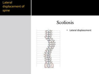 Lateral
displacement of
spine
 