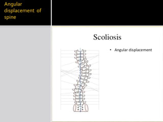 Angular
displacement of
spine
 