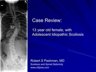 Case Review:
52°
       13 year old female, with
       Adolescent Idiopathic Scoliosis




      Robert S Pashman, MD
      Scoliosis and Spinal Deformity
      www.eSpine.com
 