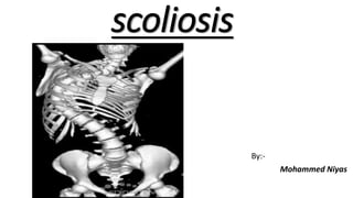 scoliosis
By:-
Mohammed Niyas
 