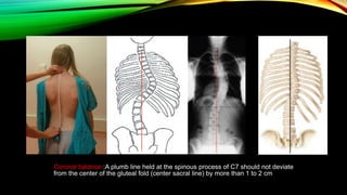 Scoliosis | PPTX